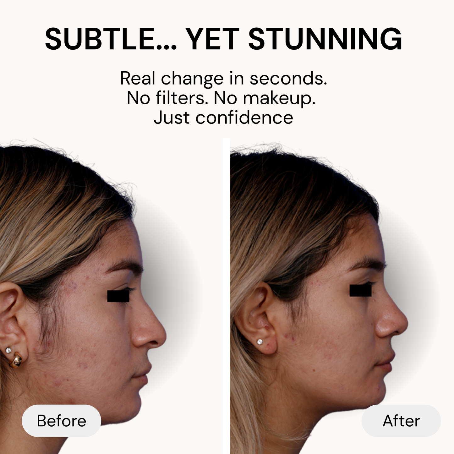Instant Invisible Nose Lift