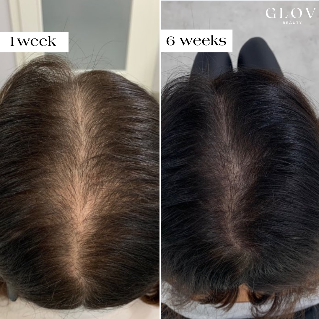 Precision Infusion for Fuller Hair