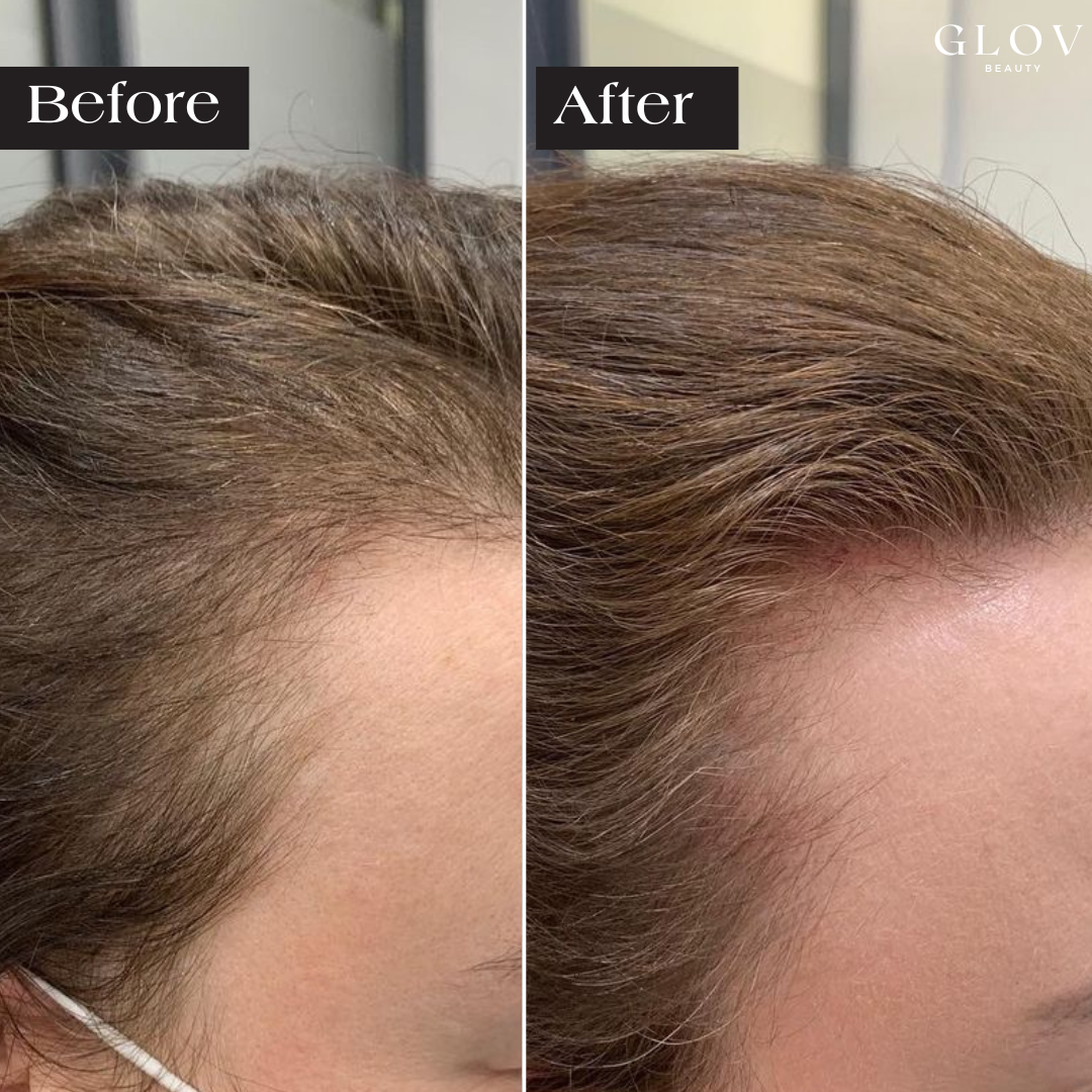 Precision Infusion for Fuller Hair