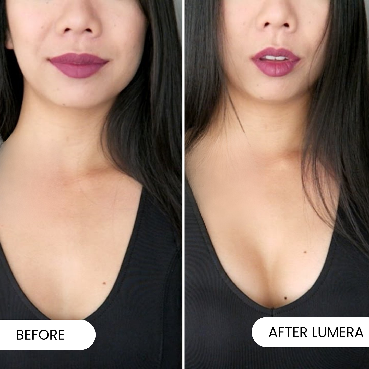 Eterna Infusion™ - Pioneer Microneedling Décolleté