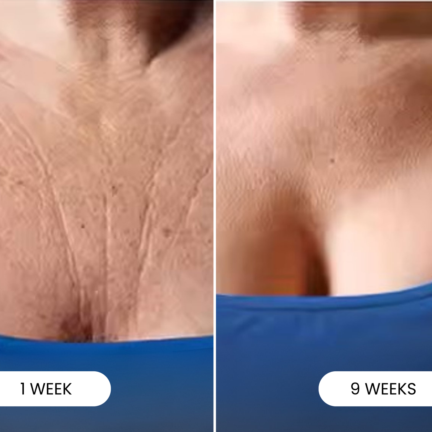 Eterna Infusion™ - Pioneer Microneedling Décolleté