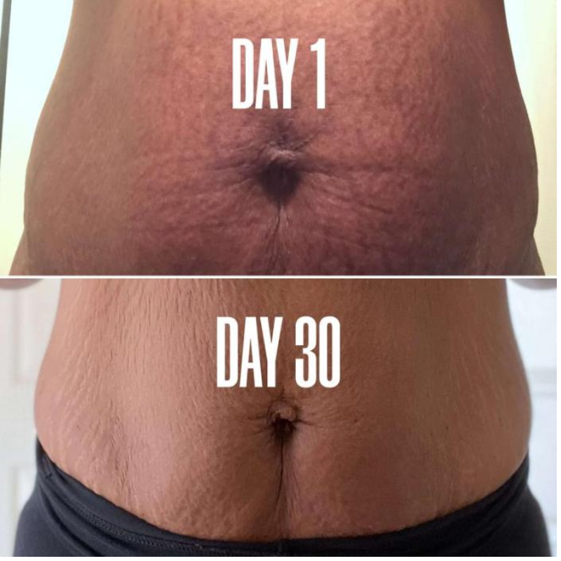Smooth Confidence Stretch Mark Cream