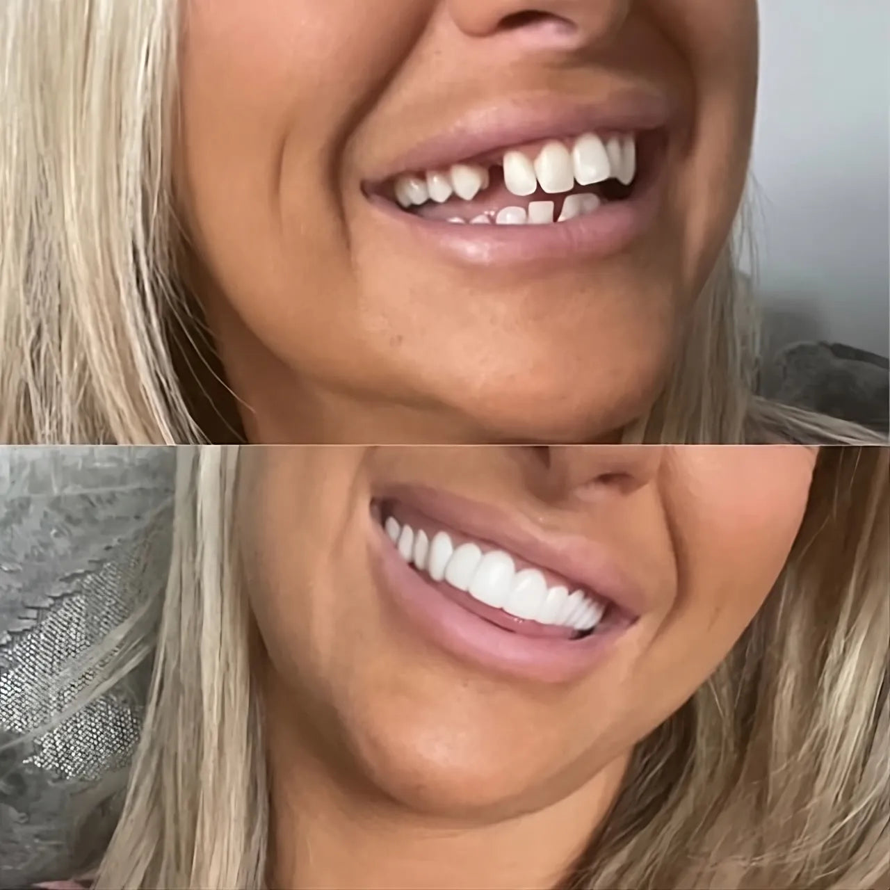 Instant Smile Confidence Boost