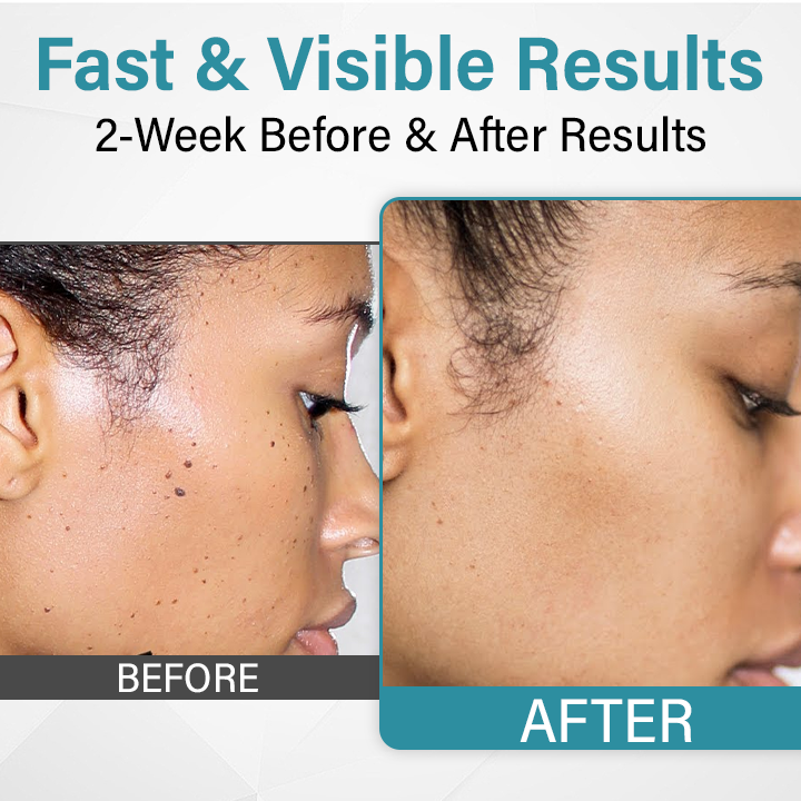 Painless Laser Mole Remover