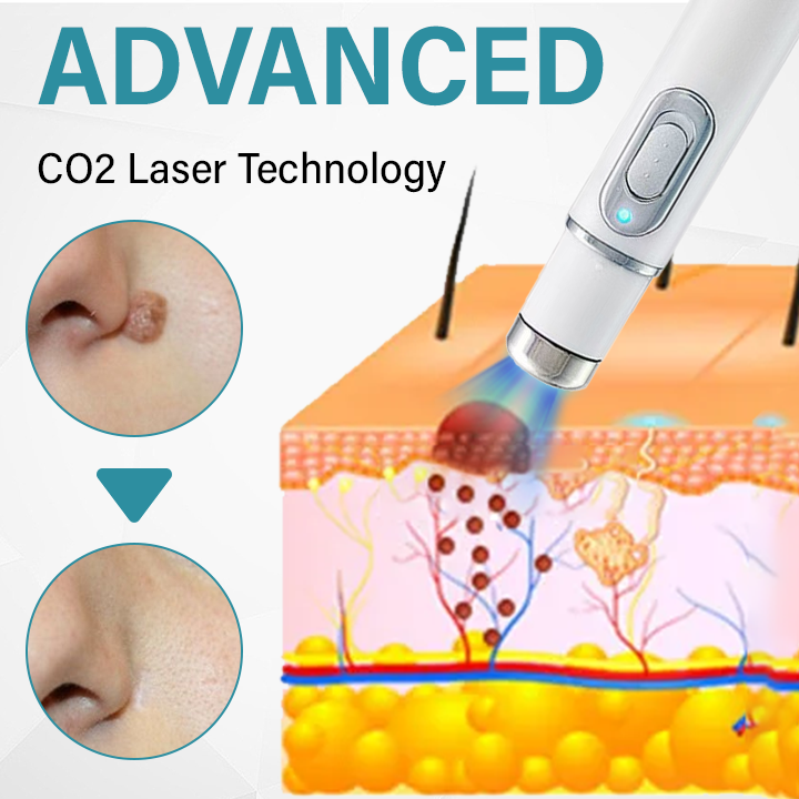Painless Laser Mole Remover