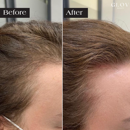 Precision Infusion for Fuller Hair