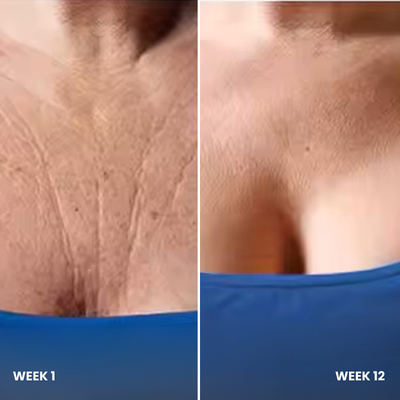 3. It Reduces Wrinkles, Stretch Marks & Crepey Skin on the Bust