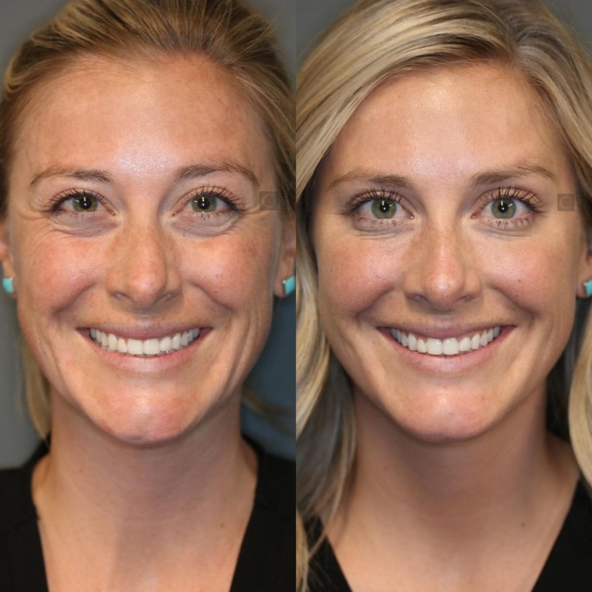 Youth Glow Wrinkle Eliminator